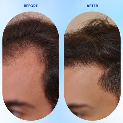 Hair Growth Roll-On Serum