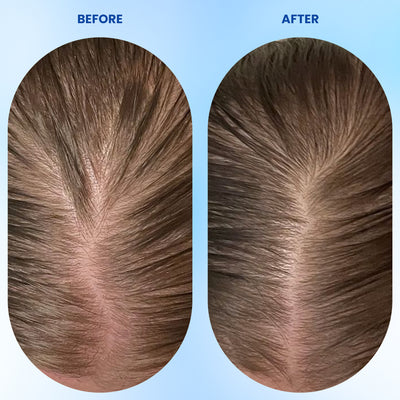 Hair Growth Roll-On Serum